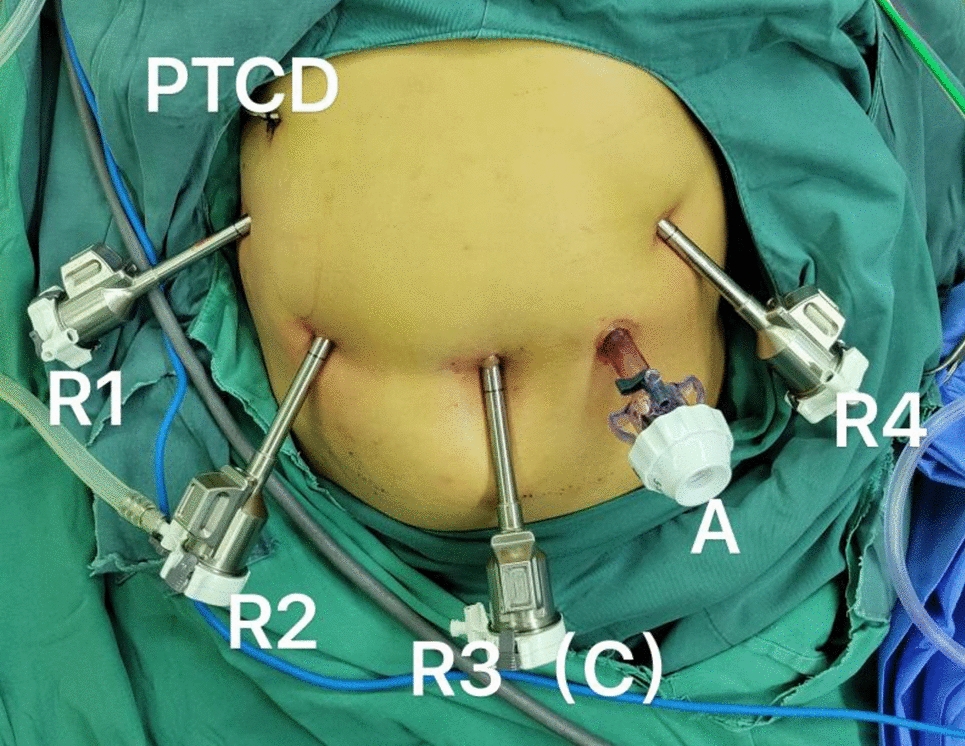 Safety and learning curve analysis of robotic-assisted pancreaticoduodenectomy: experience of a single surgeon