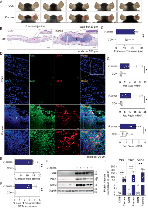 NLRP3 inflammasome activation and NETosis positively regulate each other and exacerbate proinflammatory responses: implications of NETosis inhibition for acne skin inflammation treatment