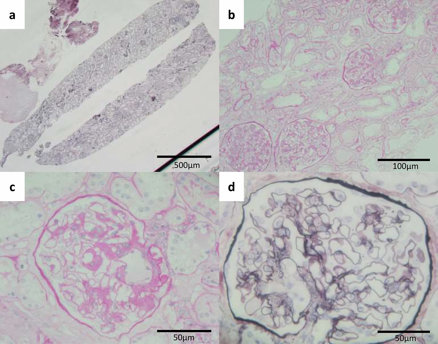 A case of non-lupus full-house nephropathy diagnosed by kidney biopsy but observed IgA nephropathy on second biopsy