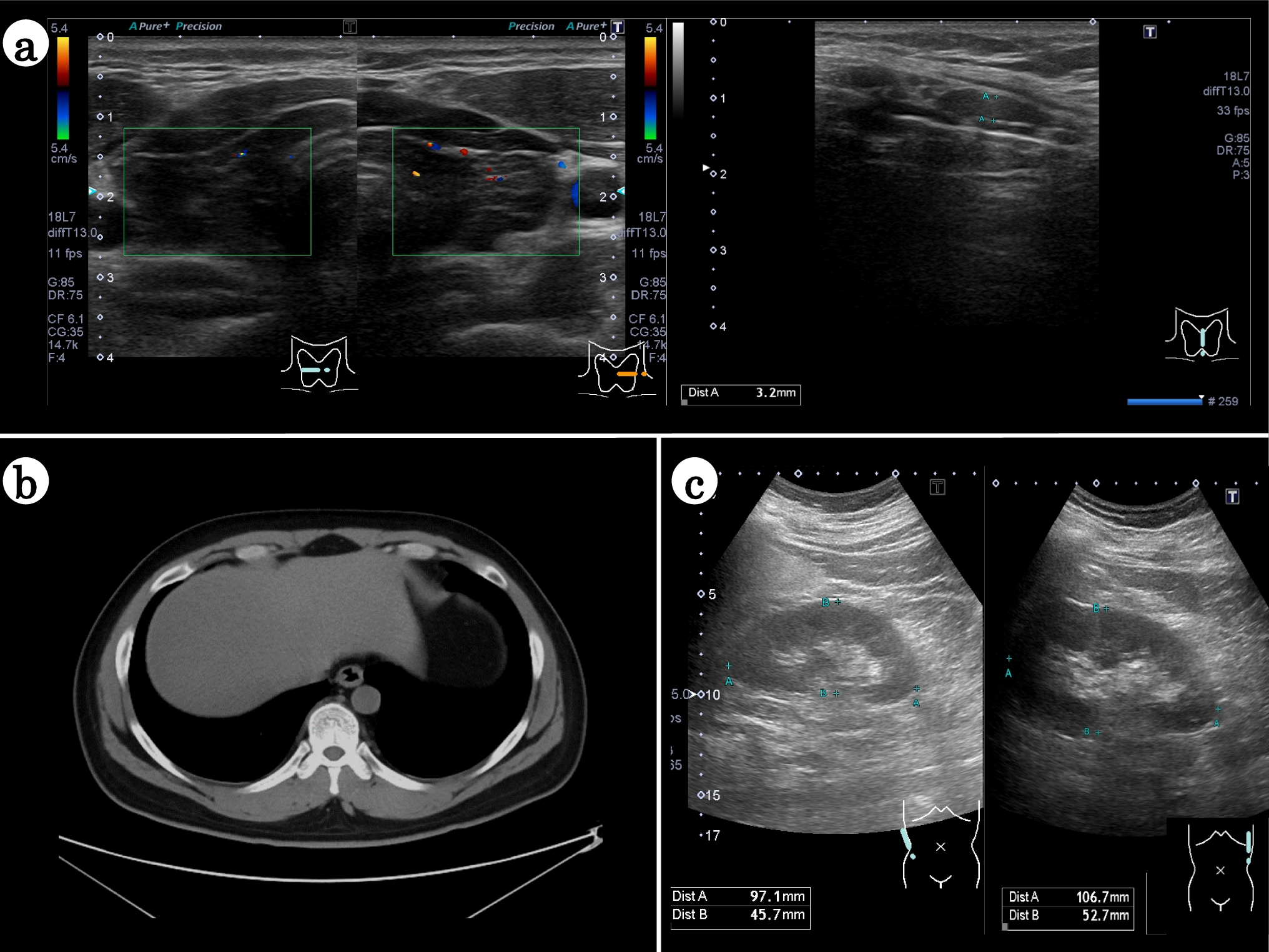 Renal dysfunction caused by severe hypothyroidism diagnosed by renal biopsy: a case report