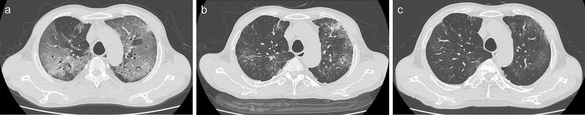 A case of late-onset organizing pneumonia following COVID-19 infection in a post-kidney transplant patient