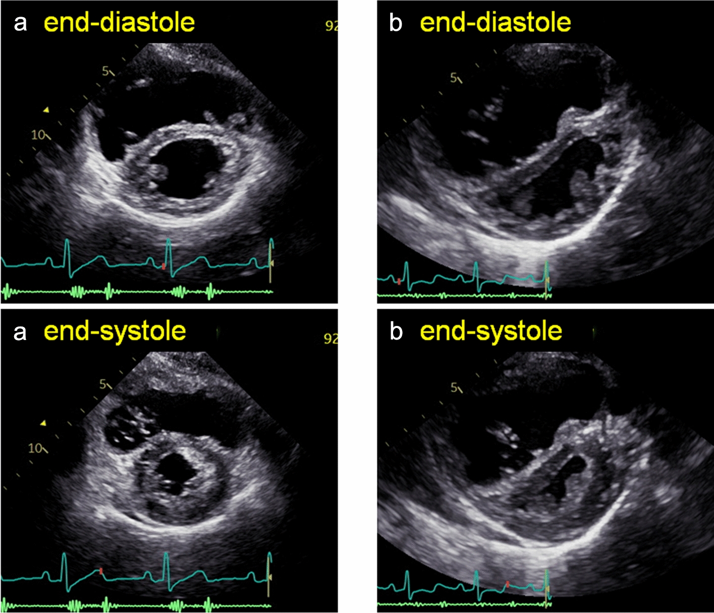Right ventricular dilatation: echocardiographic differential diagnosis