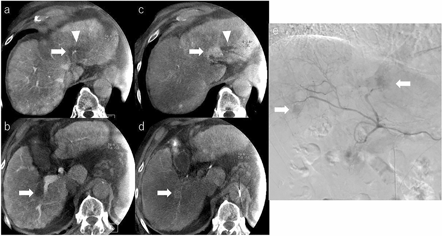 Post-embolization syndrome-like symptoms due to shedding of necrotic material of hepatocellular carcinoma into the bile duct following transcatheter arterial chemoembolization: an instructive case