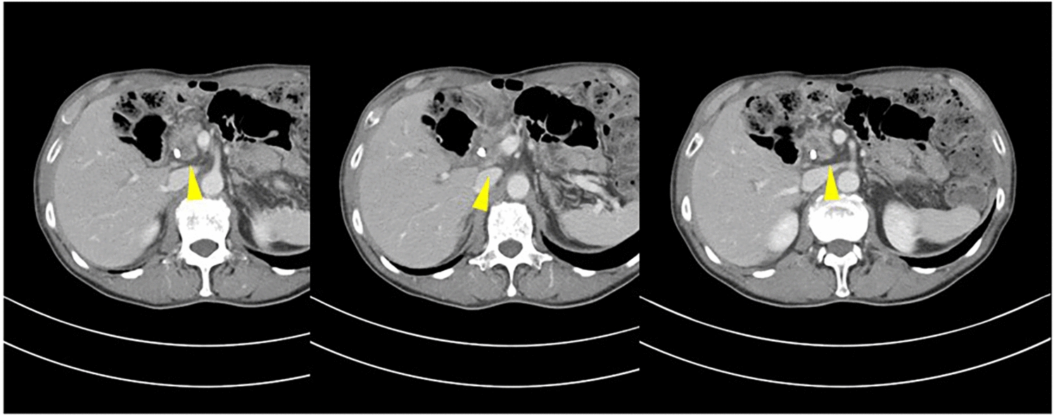 A resected case of pancreatic head cancer developing 40 years after lateral pancreaticojejunostomy for chronic pancreatitis