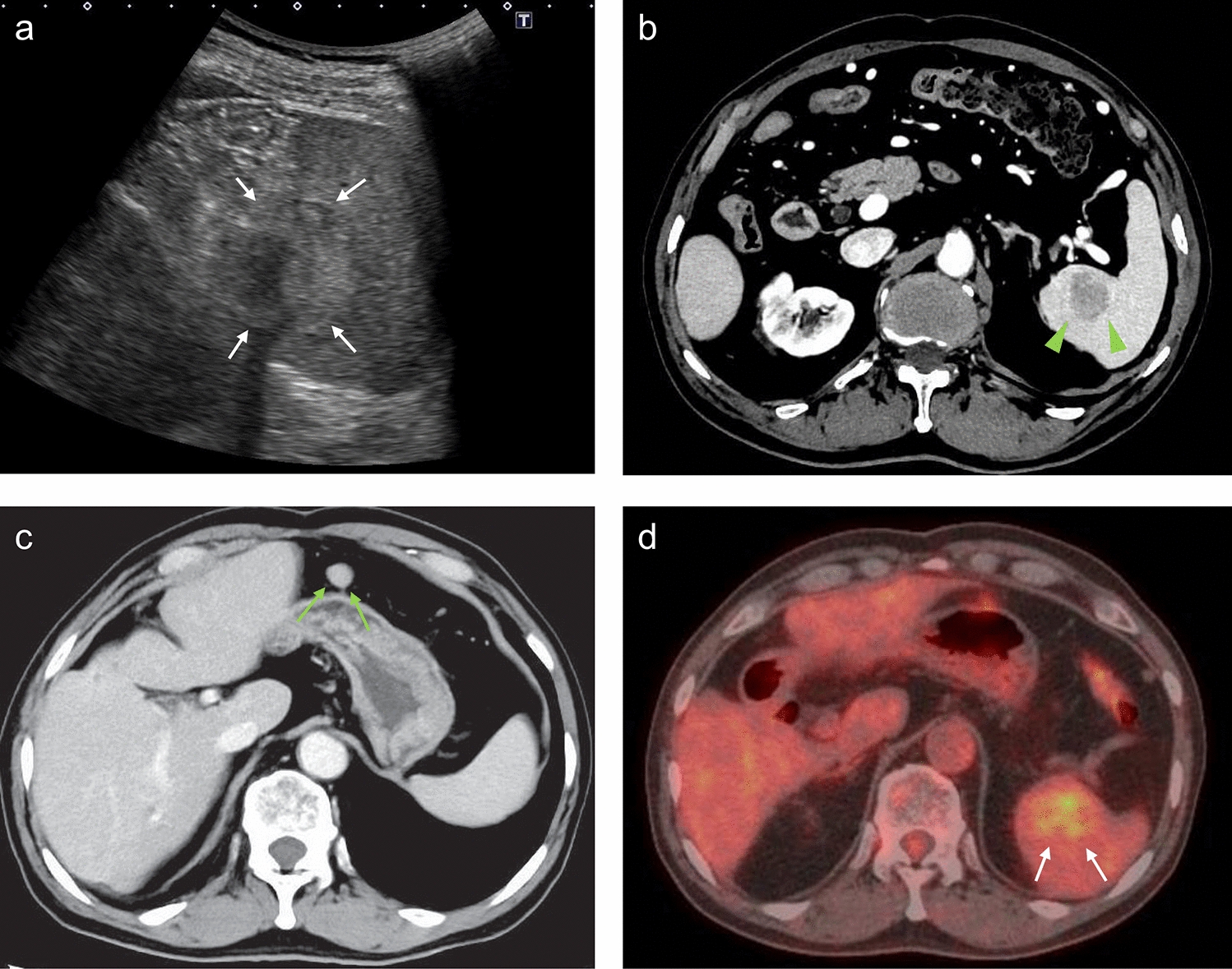 Spontaneous rupture of splenic hilar lymph node metastasis from hepatocellular carcinoma