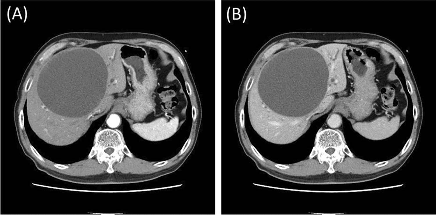 Primary hepatic chronic expanding hematoma: a case report and literature review