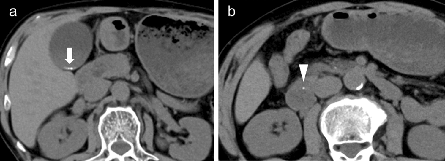 A rare incidence of a hepatic artery pseudoaneurysm following plastic biliary stent insertion