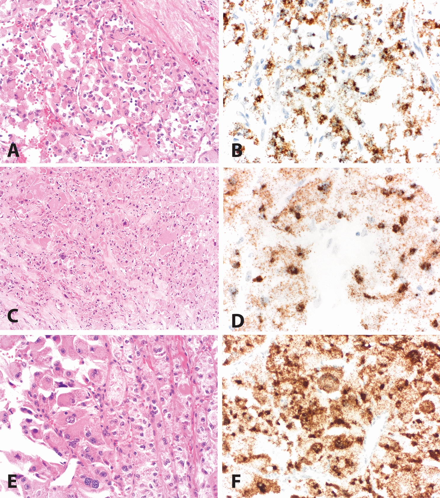 Evaluation of TRIM63 RNA in situ hybridization (RNA-ISH) as a potential biomarker for alveolar soft-part sarcoma (ASPS)