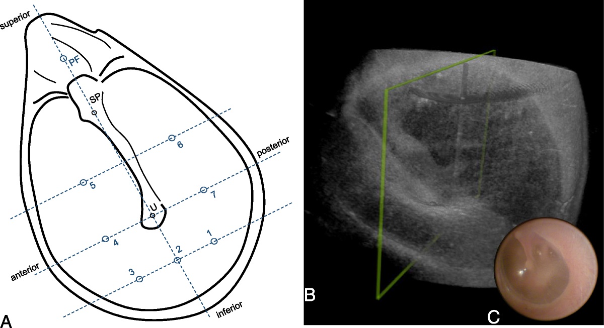 In Vivo Thickness of the Healthy Tympanic Membrane Determined by Optical Coherence Tomography