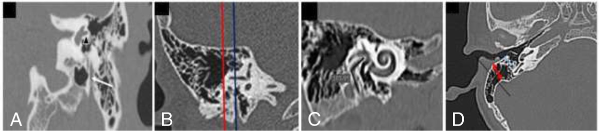 Radioclinical Assessment of Posterior Tympanotomy Difficulties during Ordinary Cochlear Implantation: A Prospective Case-Series Study