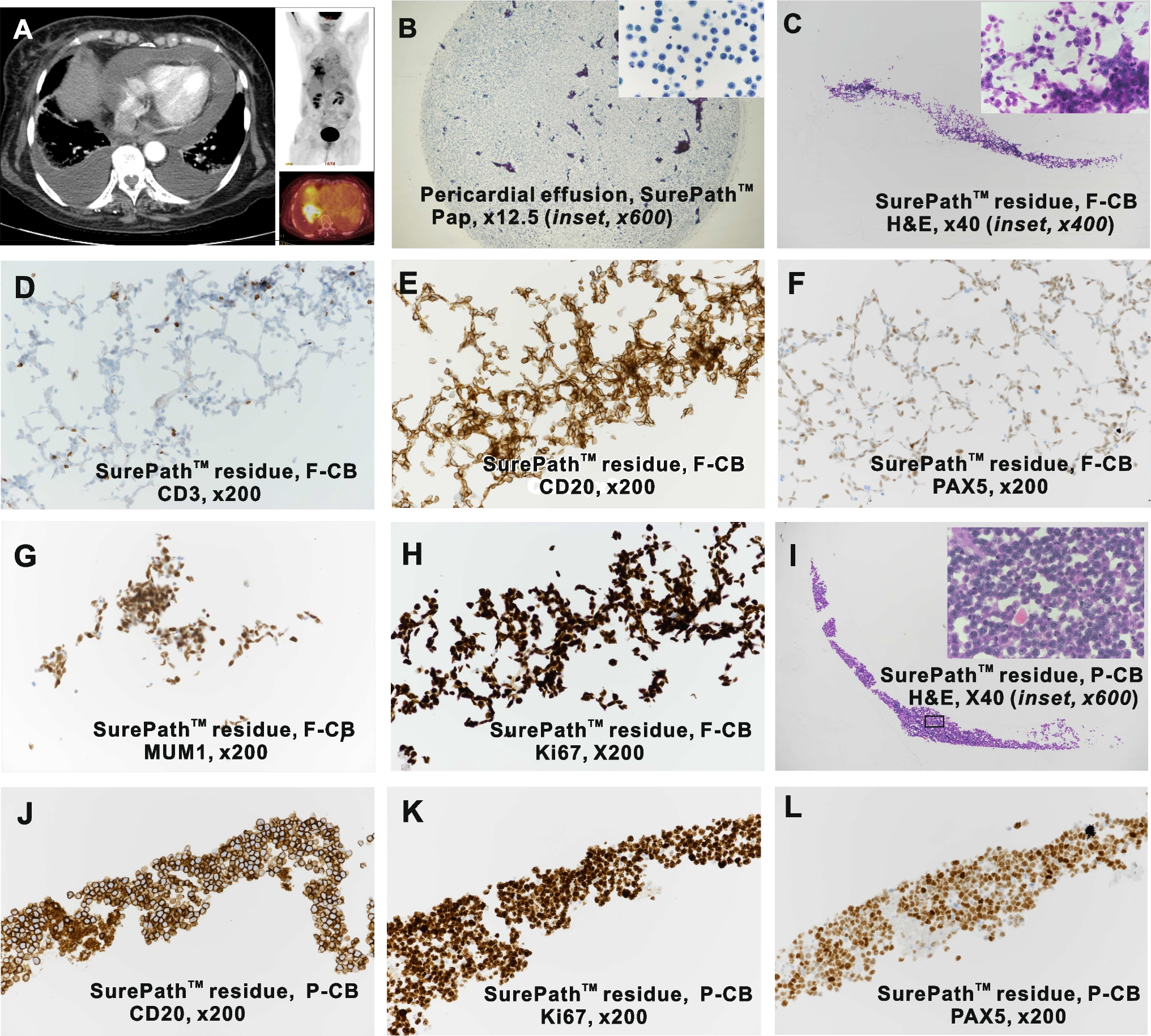 Correction to: Immunocytochemistry on frozen-embedded cell block for the diagnosis of hematolymphoid cytology specimen: a straightforward alternative to the conventional cell block