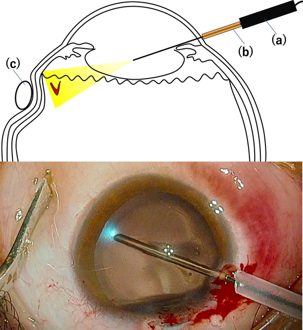 Fundus examination using a wide-angle viewing system and intraocular illumination through the corneal incision during cataract surgery: a case series