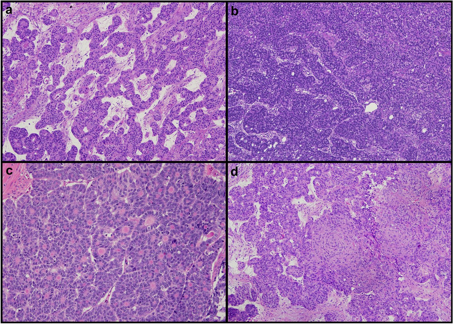 Ovarian endometrioid carcinoma with a sex cord-like pattern: a morphological, immunohistochemical, and molecular analysis