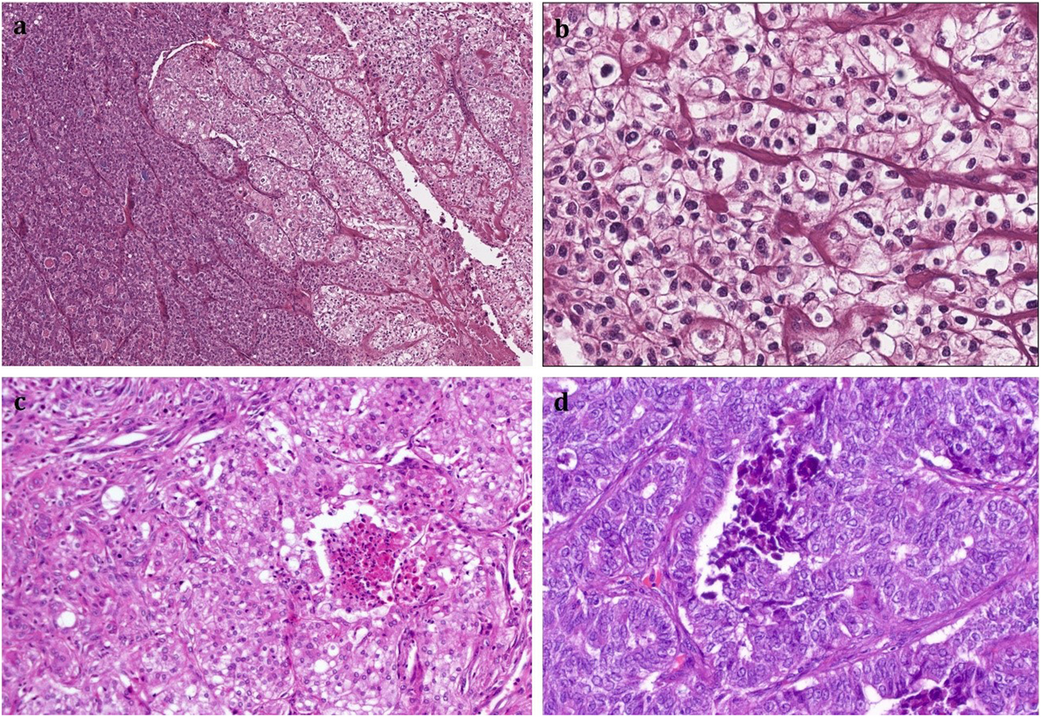 Poorly differentiated thyroid carcinomas: conceptual controversy and clinical impact