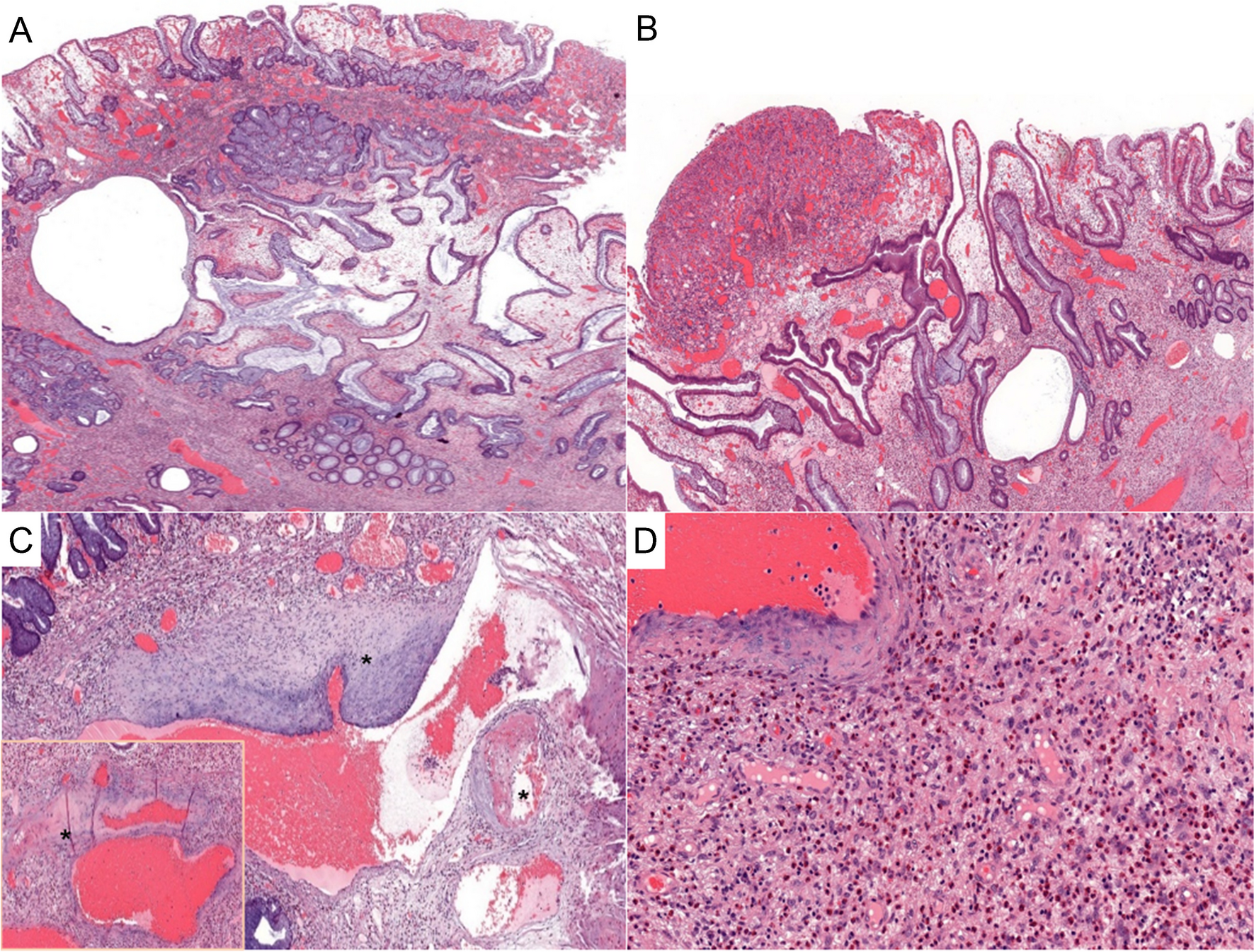 Inflammatory/juvenile-like polyps in neurofibromatosis type 1 associated with epithelial dysplasia