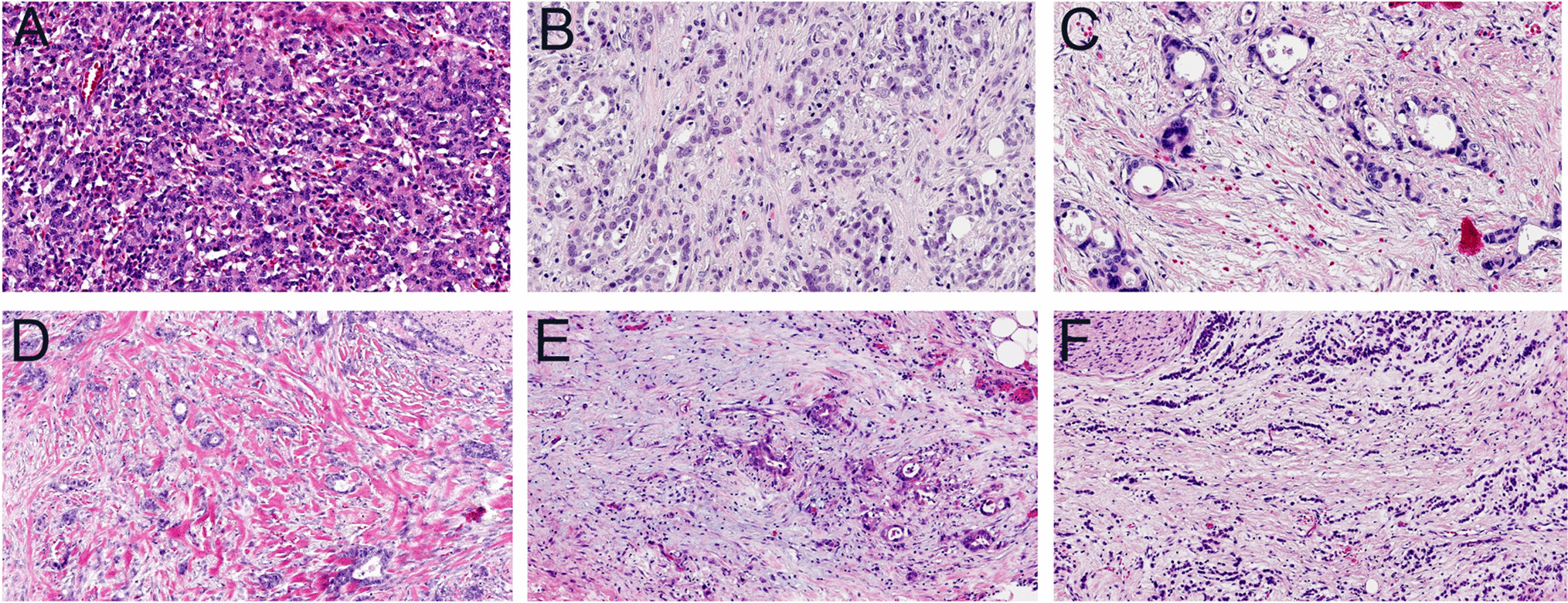 Tumor stroma ratio, tumor stroma maturity, tumor-infiltrating immune cells in relation to prognosis, and neoadjuvant therapy response in esophagogastric junction adenocarcinoma