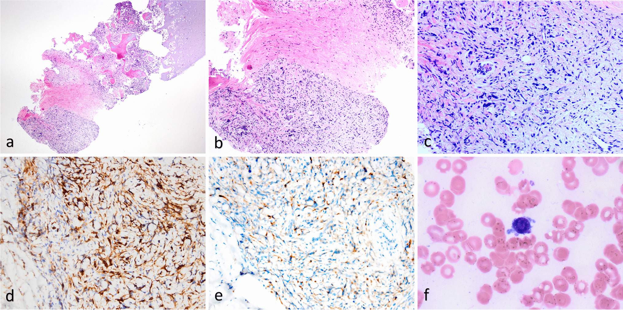 Myeloid sarcoma with RBM15::MRTFA (MKL1) mimicking vascular neoplasm
