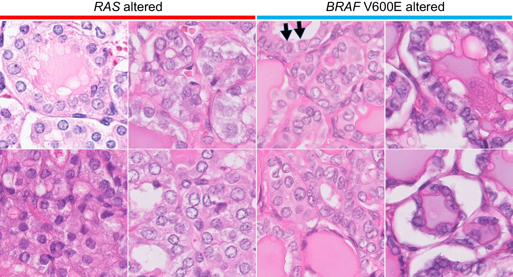 Differentiating BRAF V600E- and RAS-like alterations in encapsulated follicular patterned tumors through histologic features: a validation study