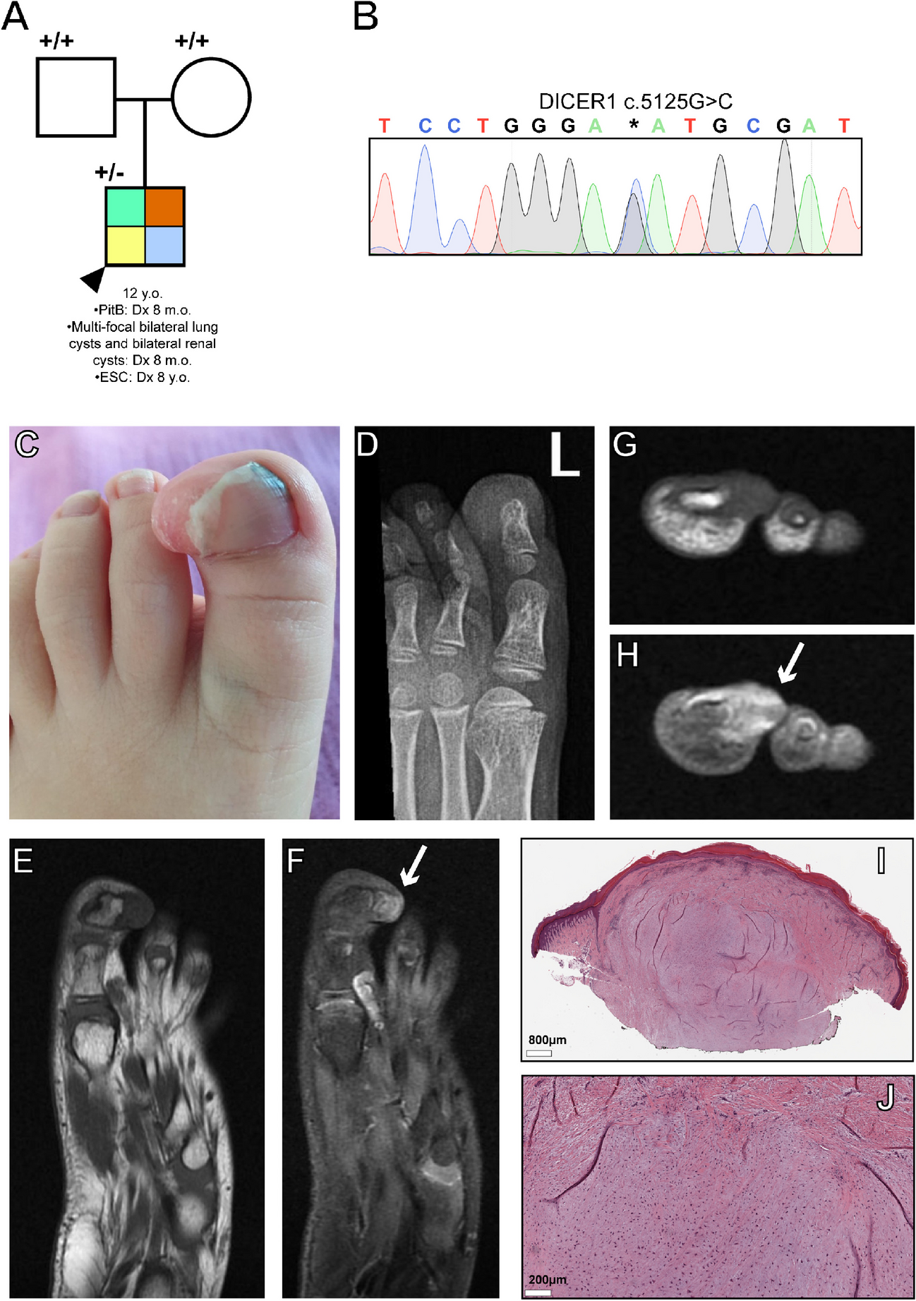 Extraskeletal chondroma of the toe in a child with DICER1 tumor predisposition syndrome: support for a dominant negative mechanism