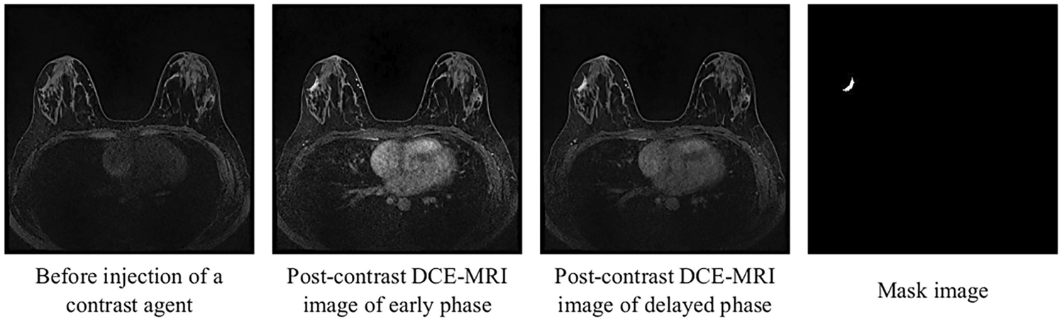 Computerized Segmentation Method for Nonmasses on Breast DCE-MRI Images Using ResUNet++ with Slice Sequence Learning and Cross-Phase Convolution
