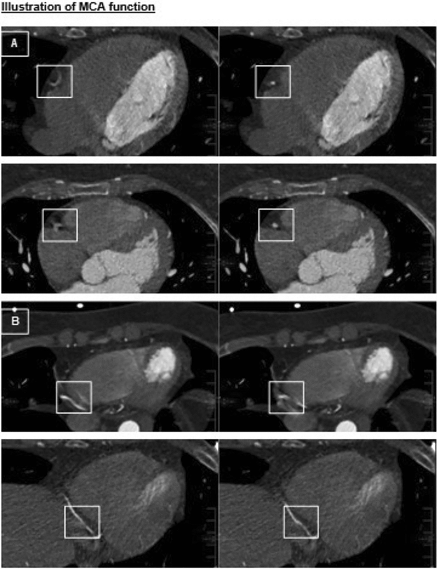 Optimizing Coronary Computed Tomography Angiography Using a Novel Deep Learning-Based Algorithm