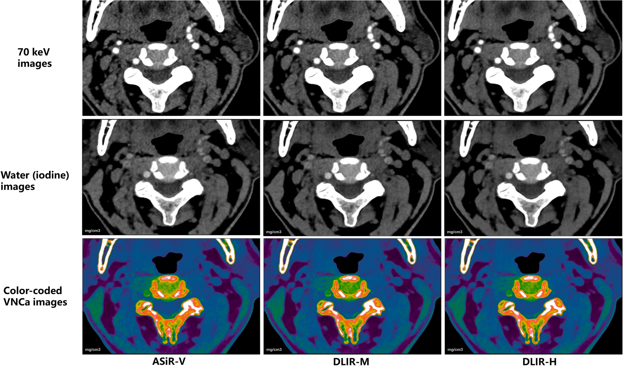 Deep Learning Imaging Reconstruction Algorithm for Carotid Dual Energy CT Angiography: Opportunistic Evaluation of Cervical Intervertebral Discs—A Preliminary Study