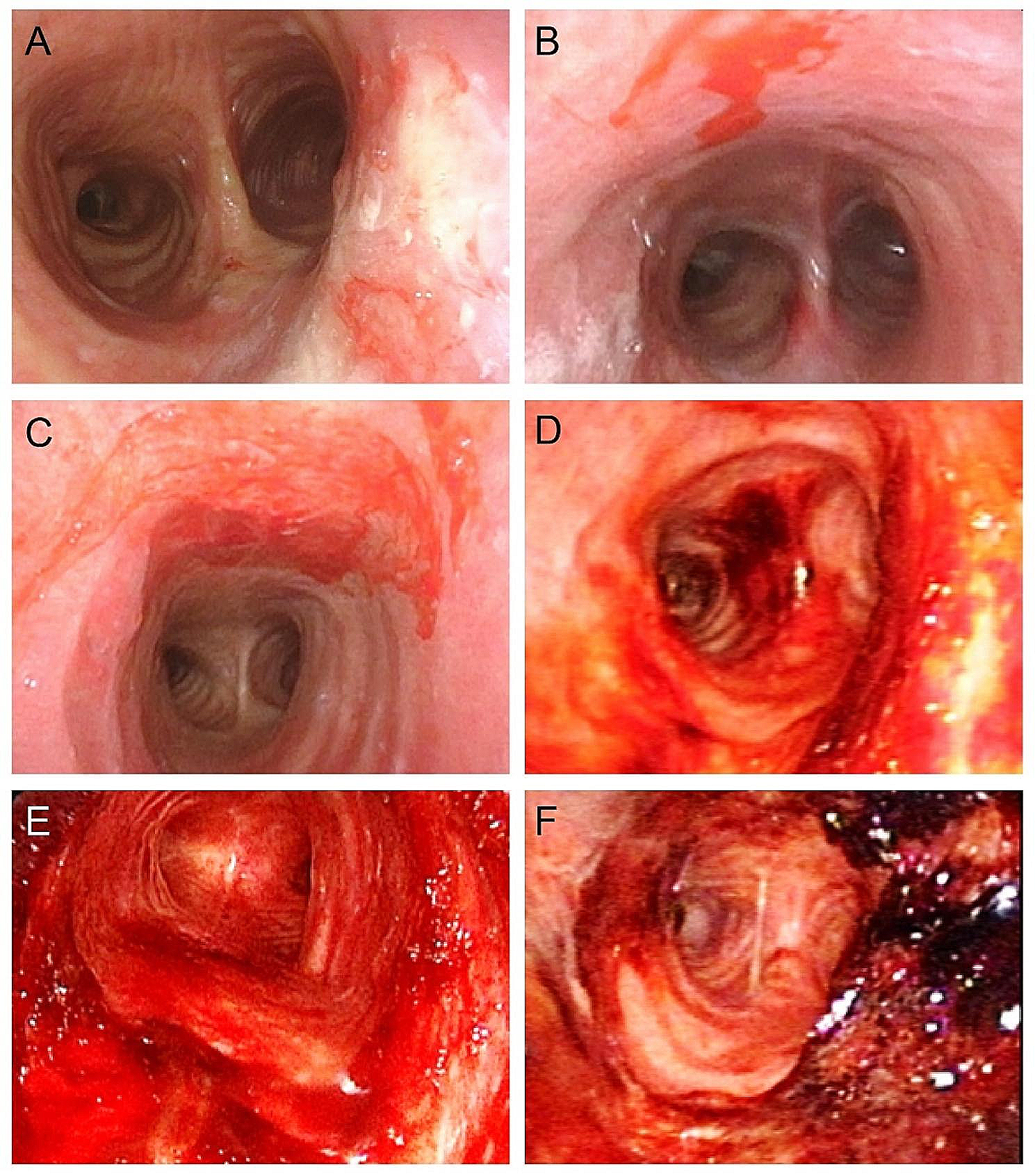 SARS-CoV-2 infection increases airway bleeding risk in patients after tracheostomies