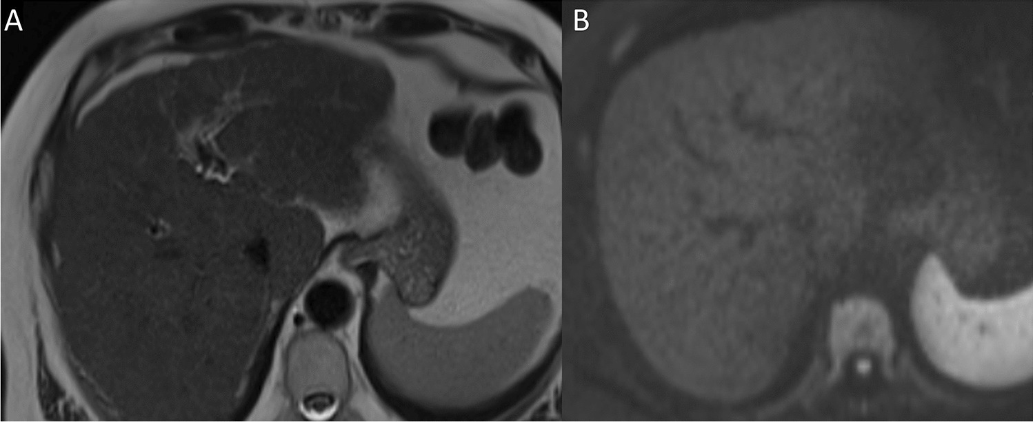 Abbreviated magnetic resonance imaging in hepatocellular carcinoma surveillance: A review