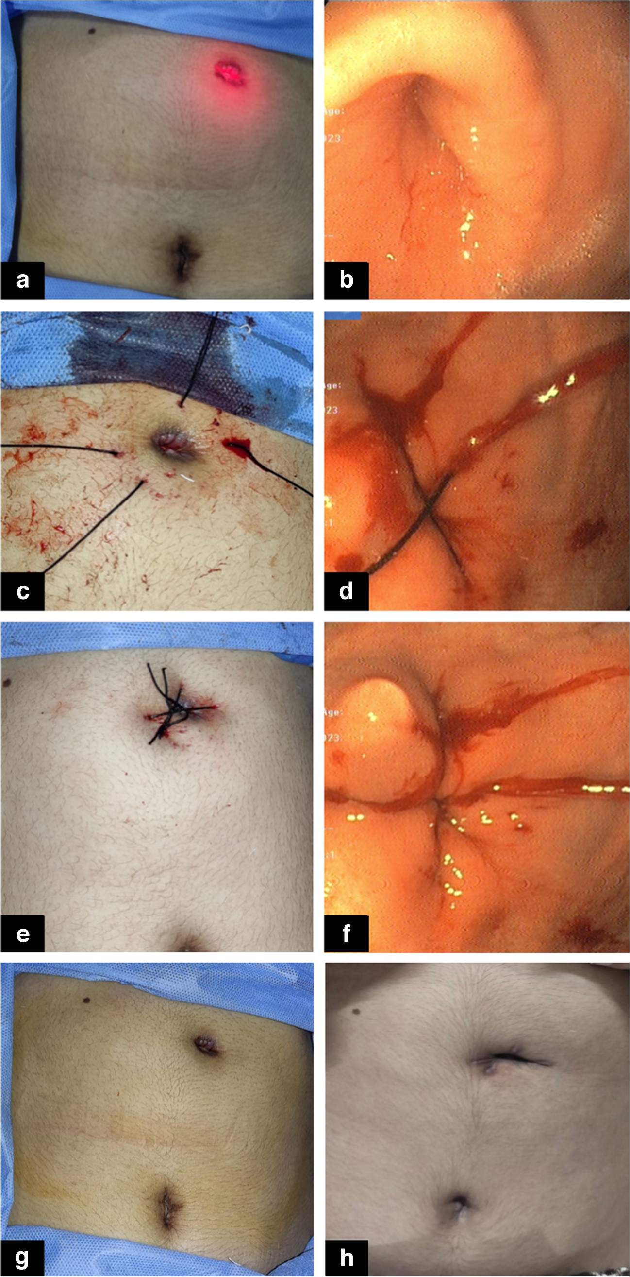 Gastroscopy-guided percutaneous suturing for closure of persistent gastrocutaneous fistula: A novel and cost-effective method