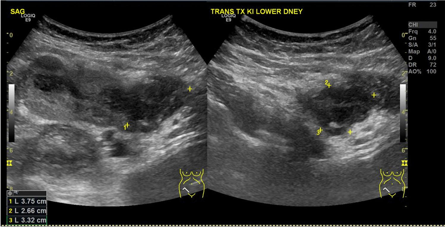 Multifocal lesions in a kidney allograft