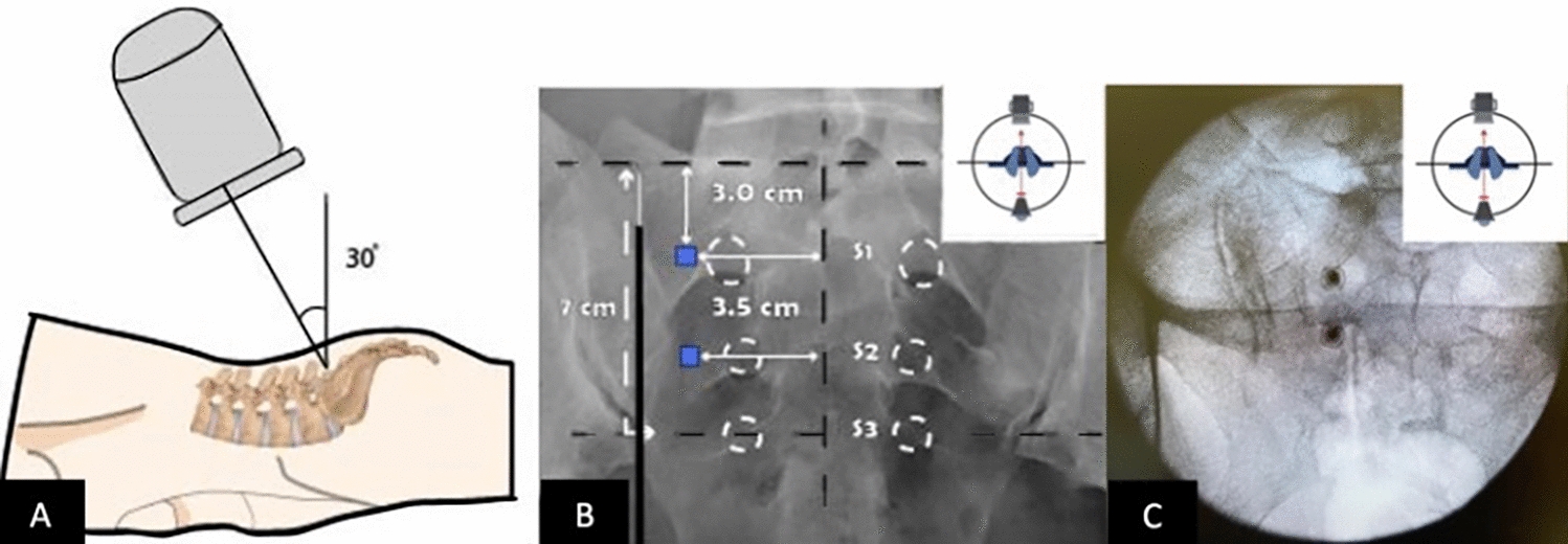 Sacroiliac Joint Denervation—A Novel Approach to Target Sacral Lateral Branches: A Practical Approach