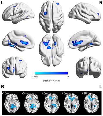 Research on adults with subthreshold depression after aerobic exercise: a resting-state fMRI study based on regional homogeneity (ReHo)