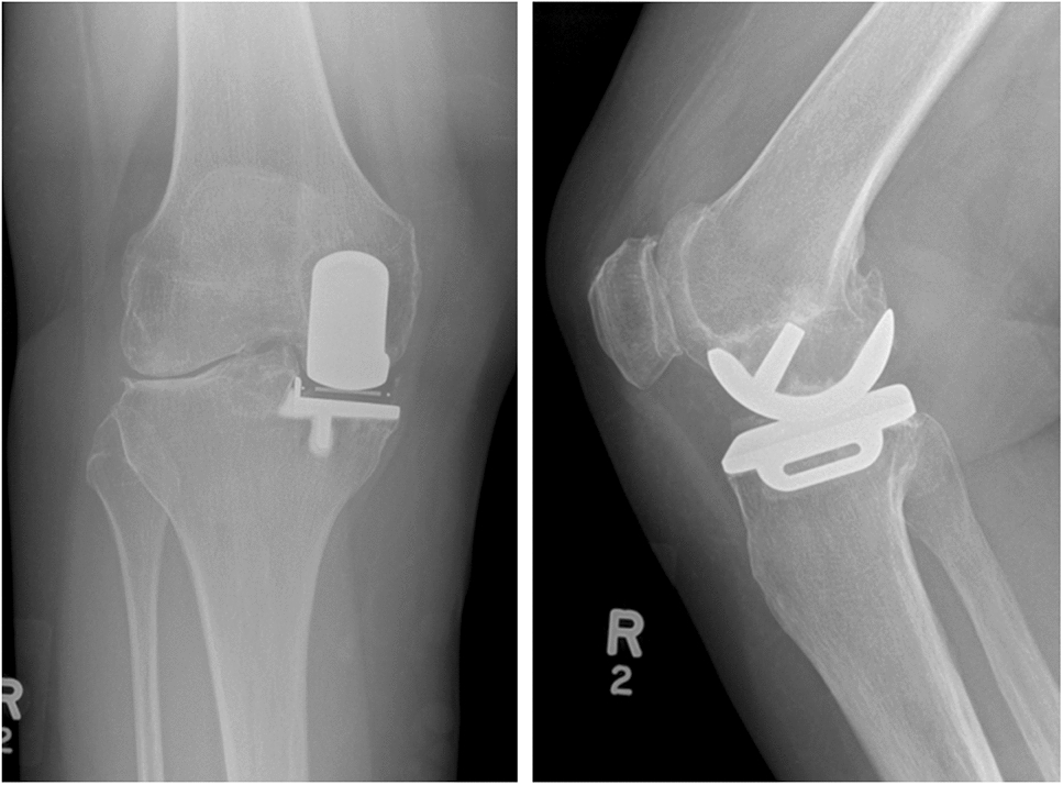 Fixed lateral unicompartmental knee replacement is a reliable treatment for lateral compartment osteoarthritis after mobile-bearing medial unicompartmental replacement