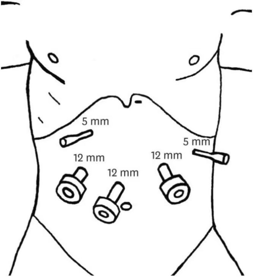 Application of hand-sewn esophagojejunostomy in laparoscopic total gastrectomy