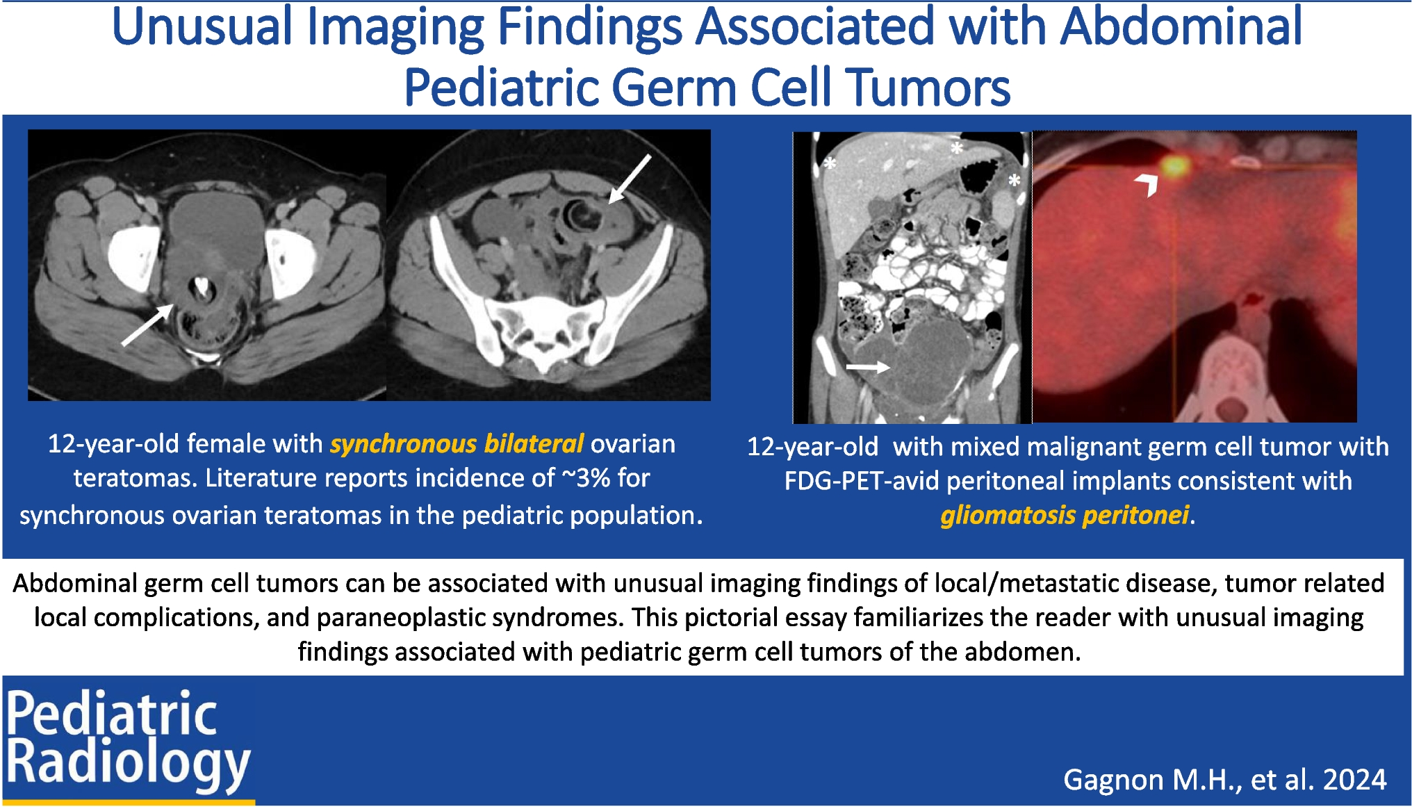 Unusual imaging findings associated with abdominal pediatric germ cell tumors