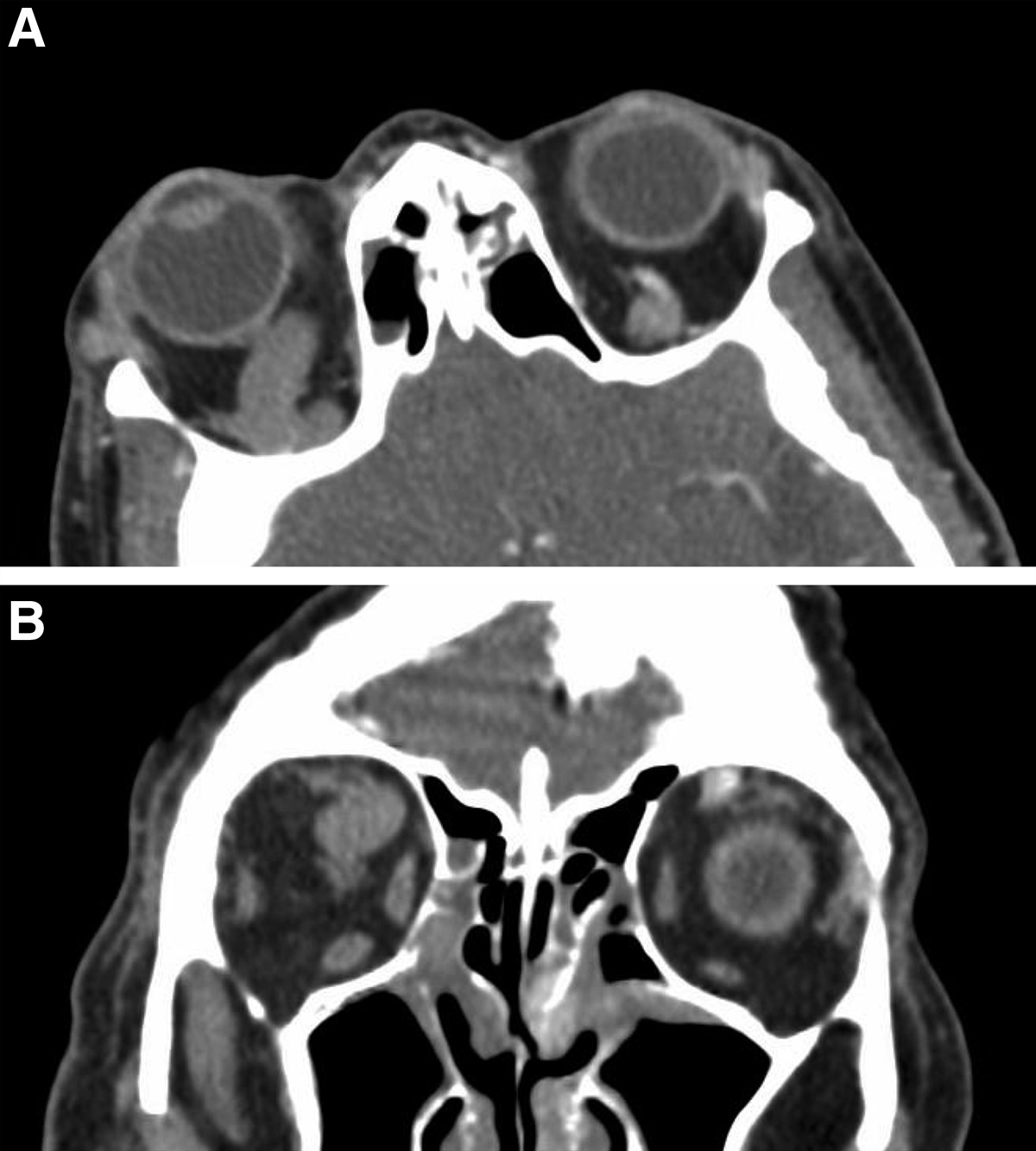 Superior Ophthalmic Vein Thrombosis Associated With Asymptomatic COVID-19 Infection