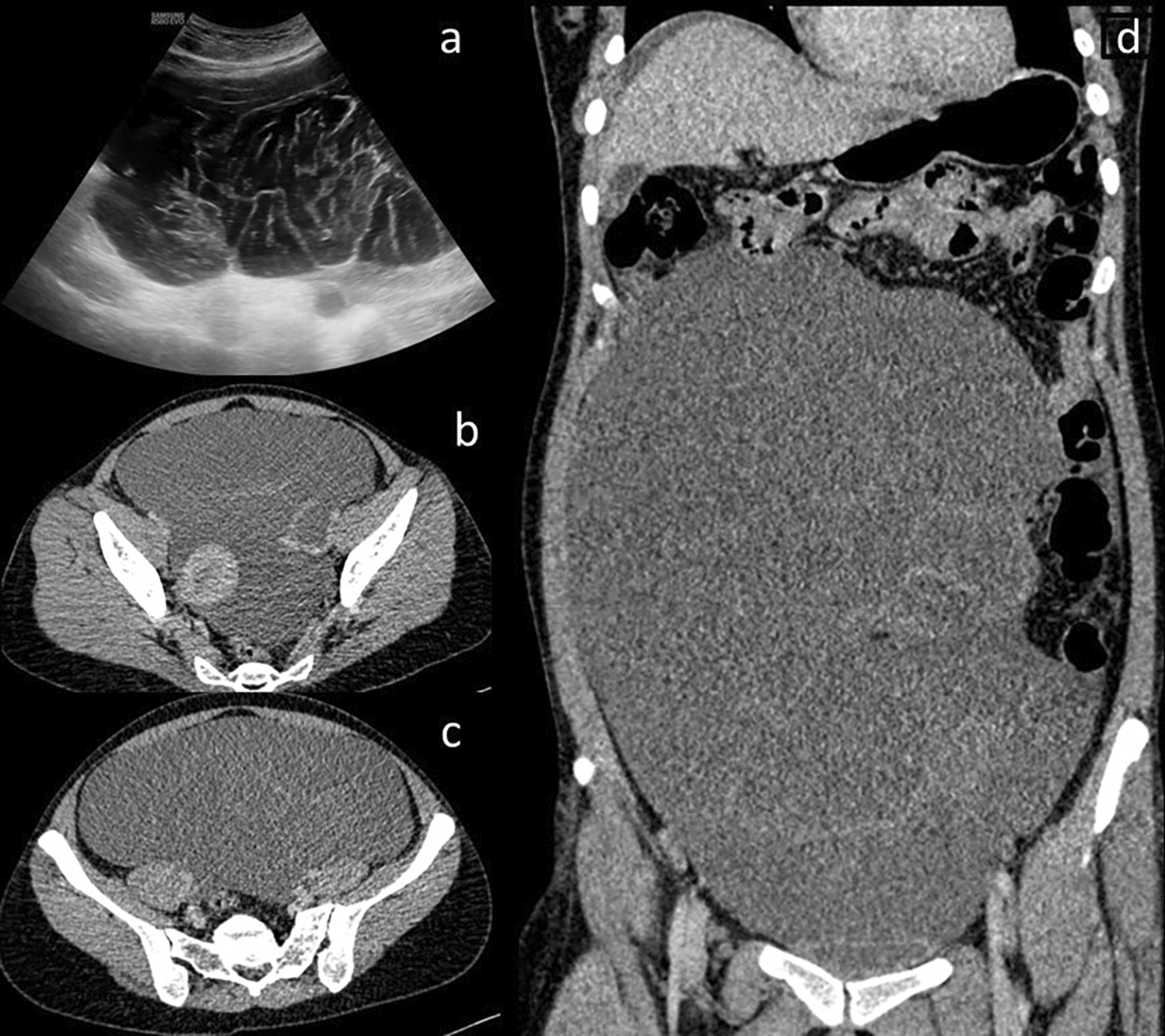 Bilateral Mucinous Cystic Ovarian Tumours: Beware of an Appendiceal Neoplasm Hiding Behind the Veil