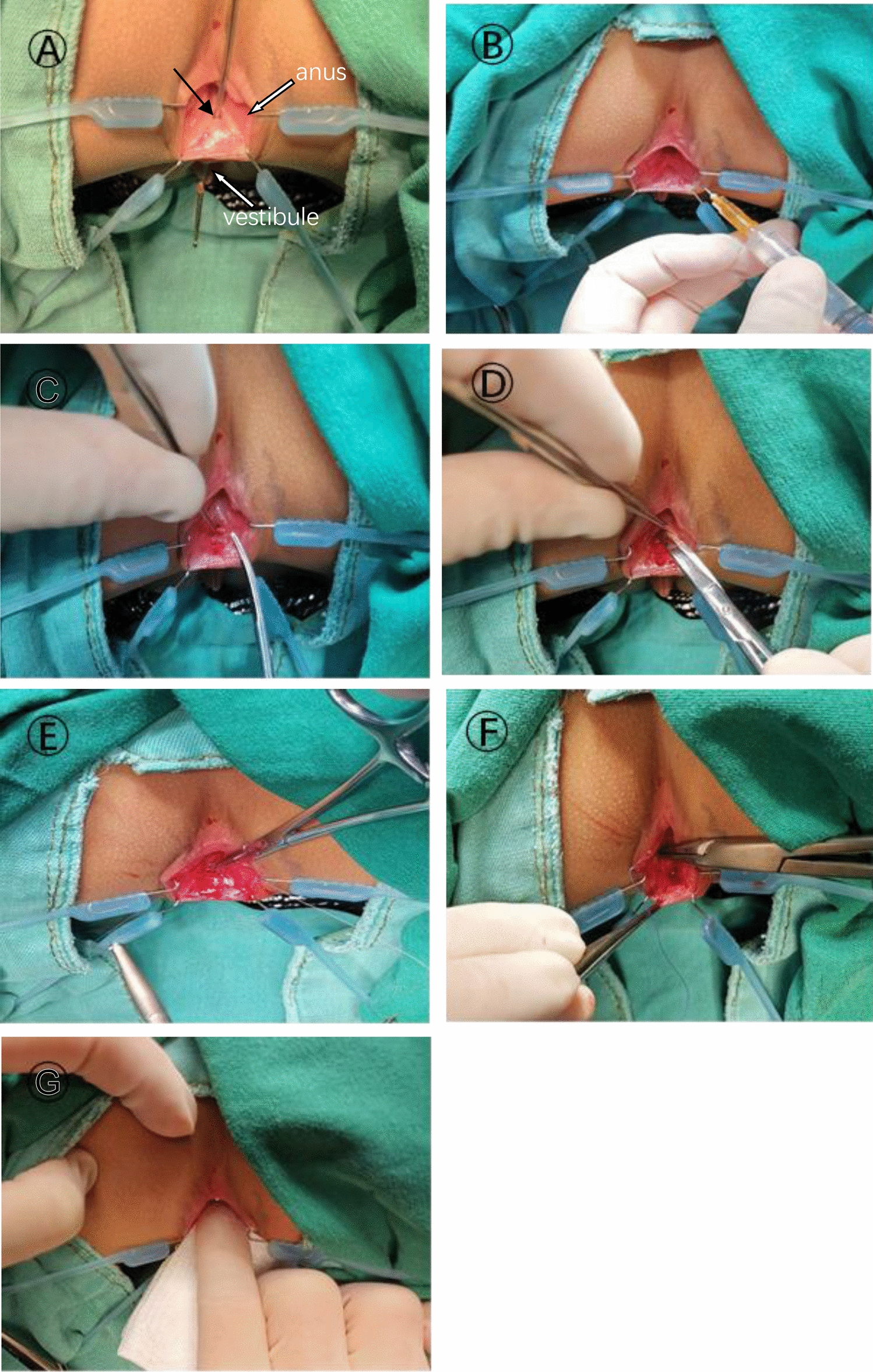 Transanal fistula repair for the treatment of rectovestibular fistula with normal anus in female children: a 5-year single-center experience