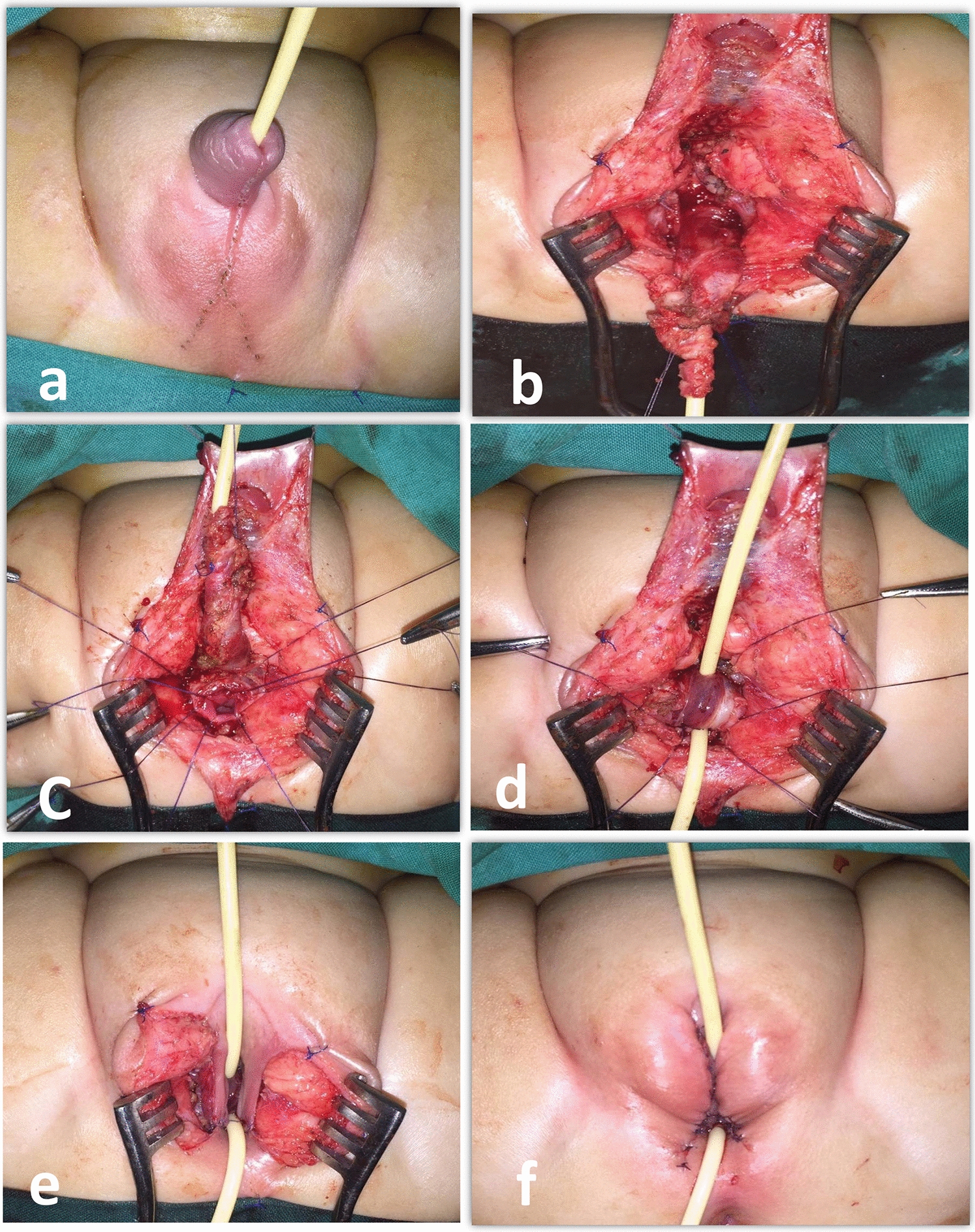 Outcomes of one-stage feminizing genitoplasty in children with congenital adrenal hyperplasia and severe virilization