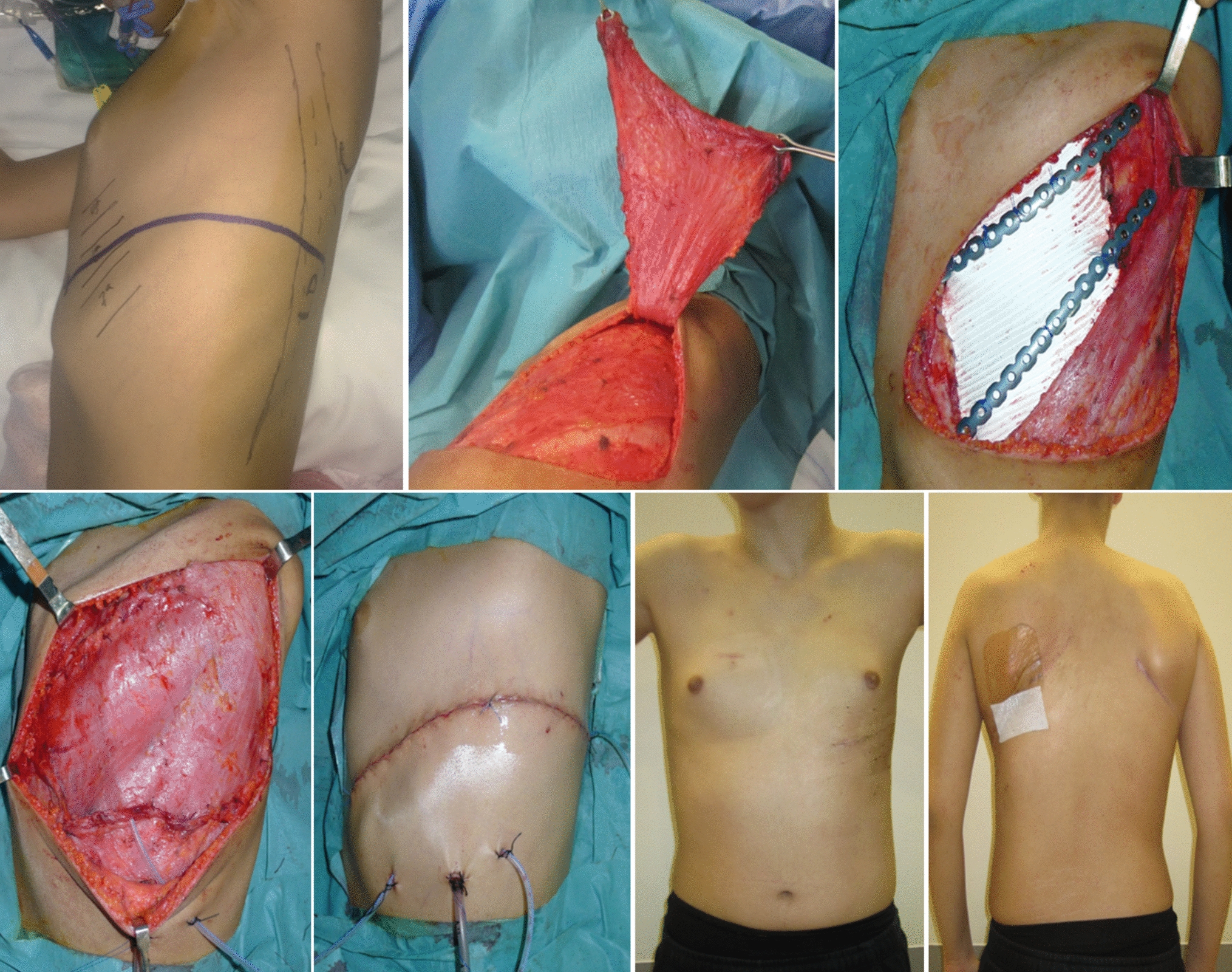 Use of pedicled flaps after oncologic resections in pediatric patients