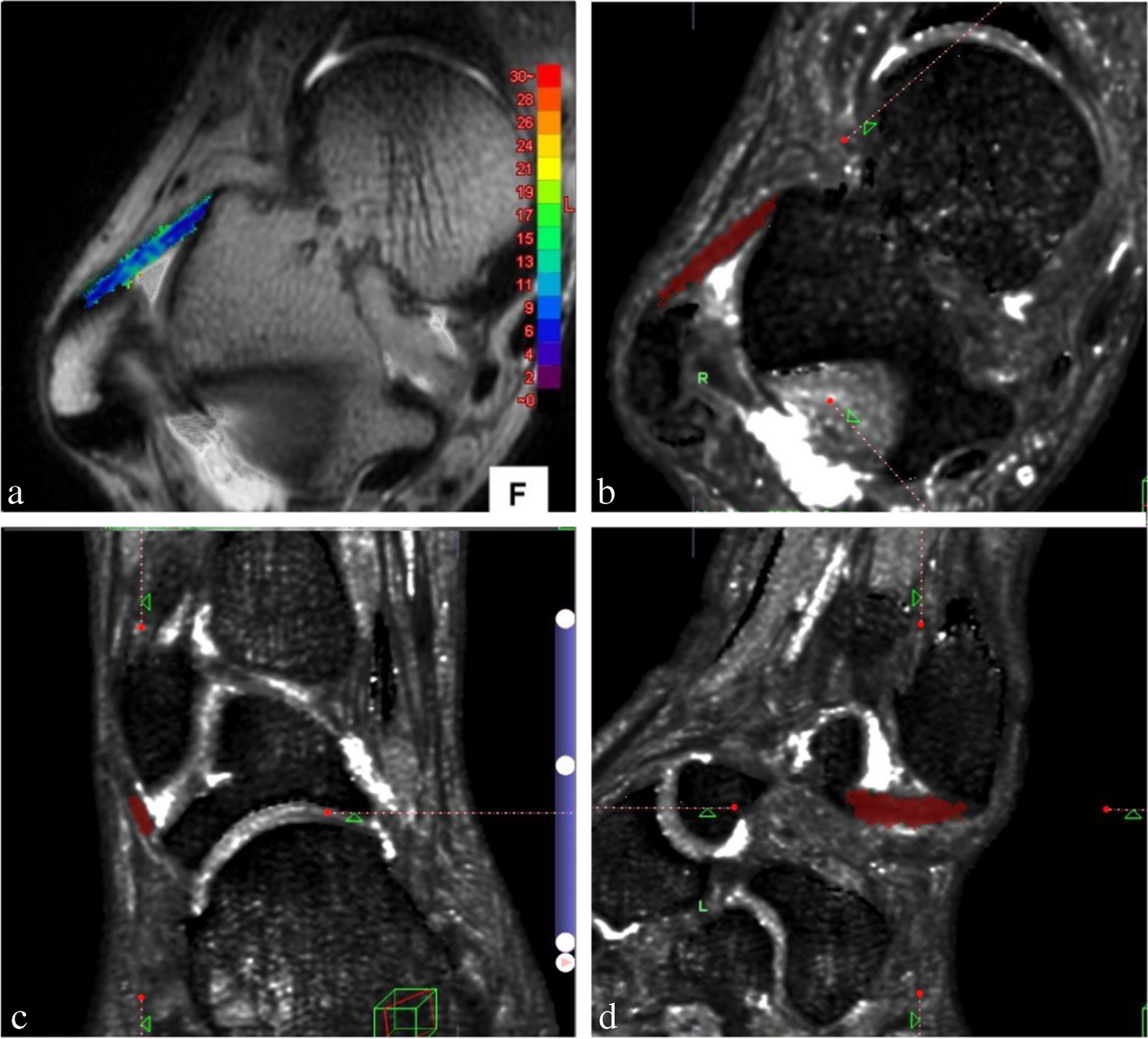 Quantitative assessment of anterior talofibular ligament quality in chronic lateral ankle instability using magnetic resonance imaging T2* value