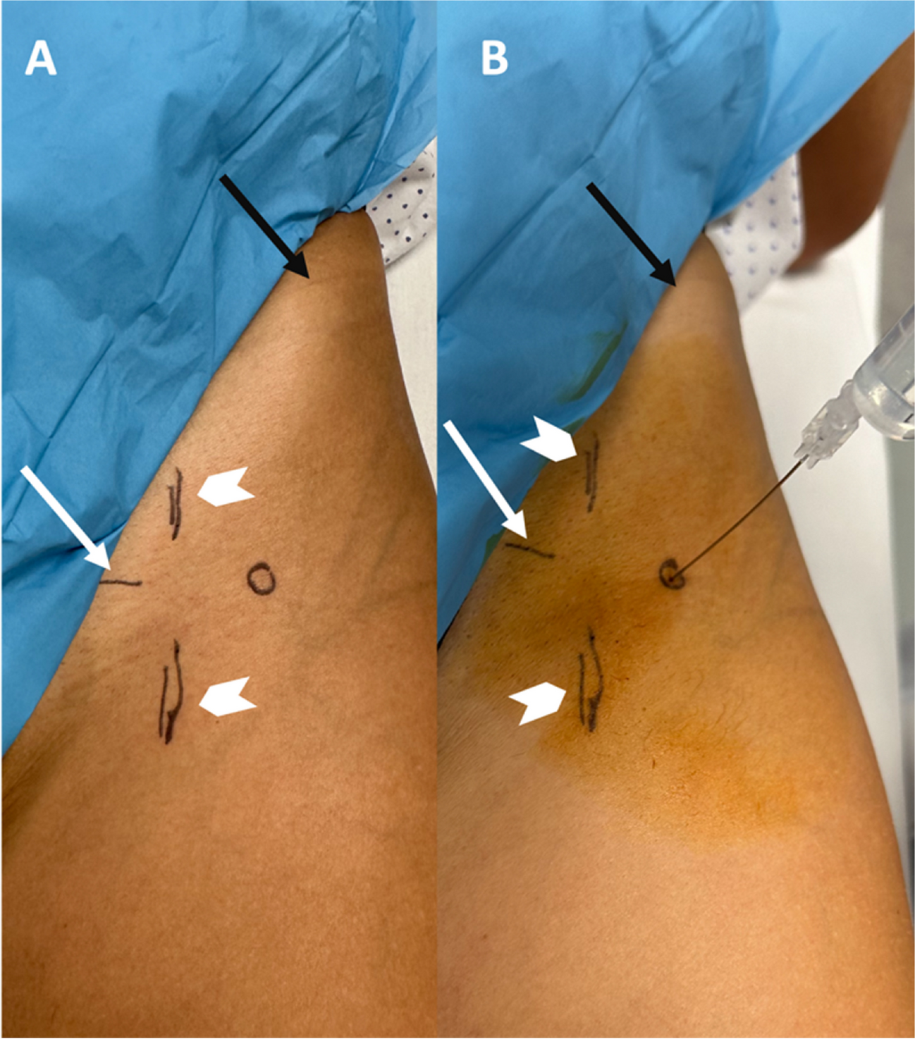 Direct MR arthrography of the hip joint: anterior approach without imaging guidance