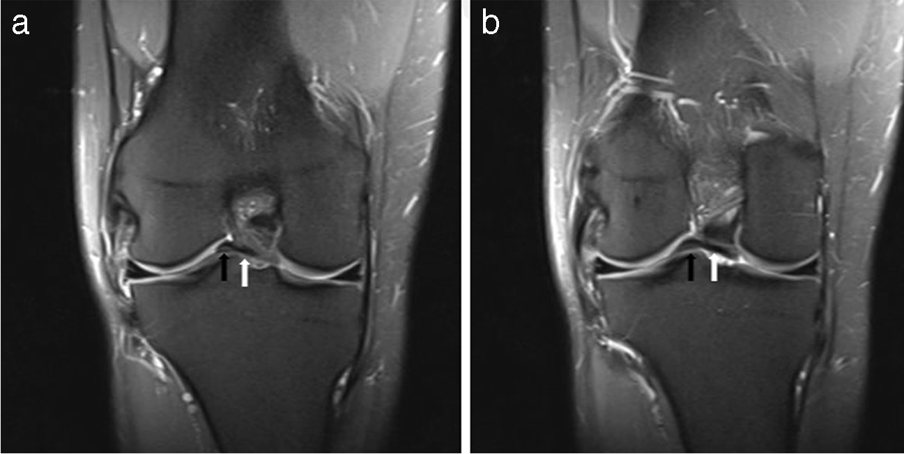 “Ring-shaped” meniscus and accompanying intermeniscal bridge meniscus: a rare combined variant resembling a bucket-handle tear