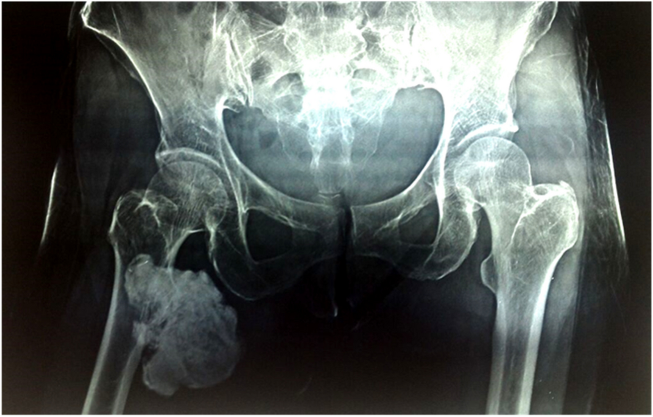Heavily calcified synovial sarcoma leading to chronic thigh pain and swelling