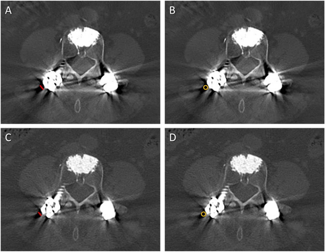 Superior metal artifact reduction of tin-filtered low-dose CT in imaging of lumbar spinal instrumentation compared to conventional computed tomography