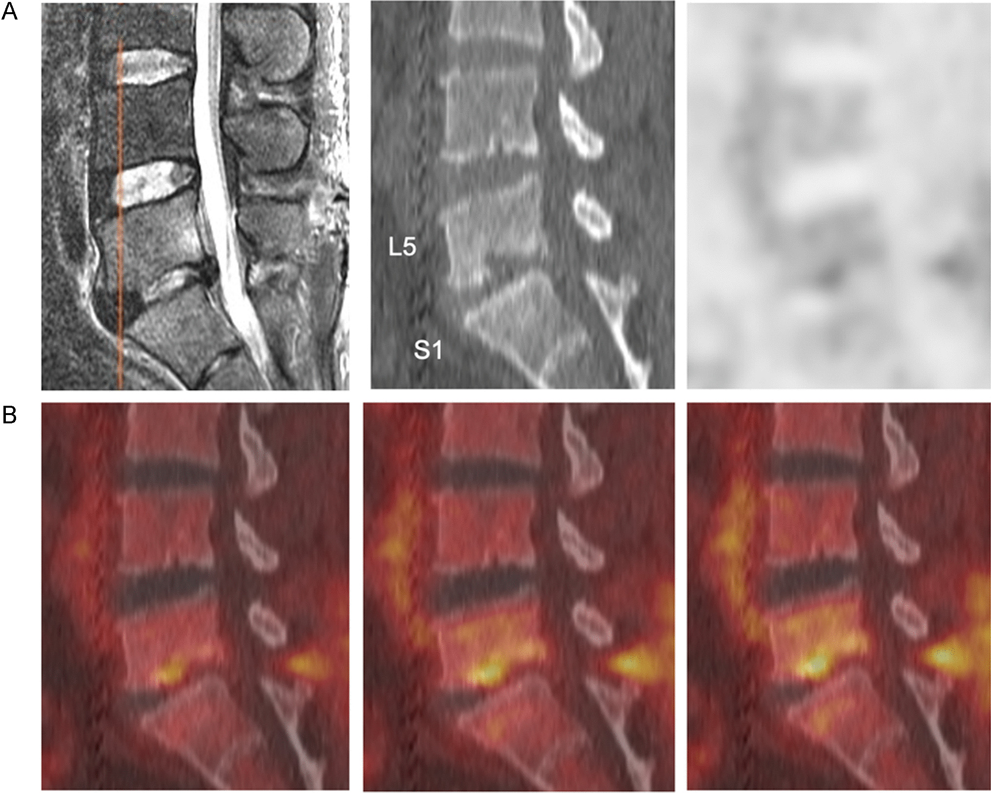 A practical approach to interpretation of 18F-fluorodeoxyglucose positron emission tomography/computed tomography for postoperative spine infection