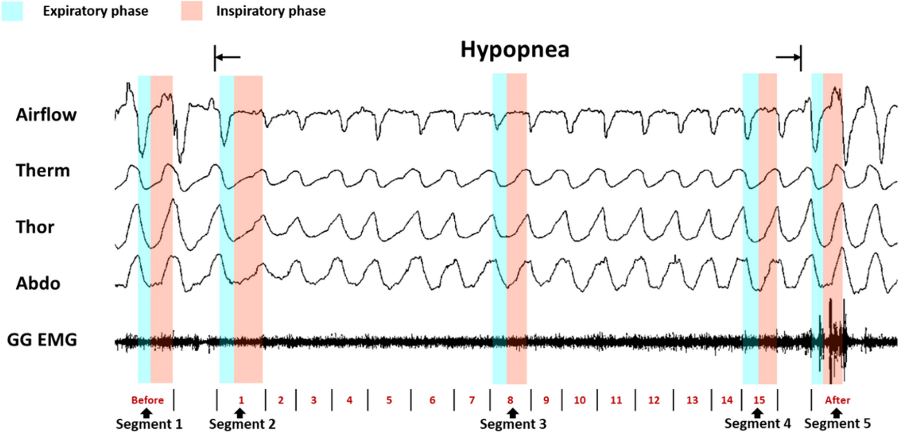 Association between overnight repetitive respiratory events and the accumulation of genioglossus fatigue in male patients with severe obstructive sleep apnea
