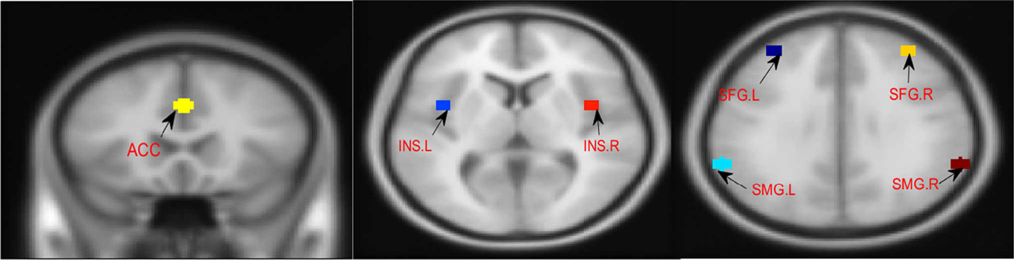 Increased functional connectivity within the salience network in patients with insomnia