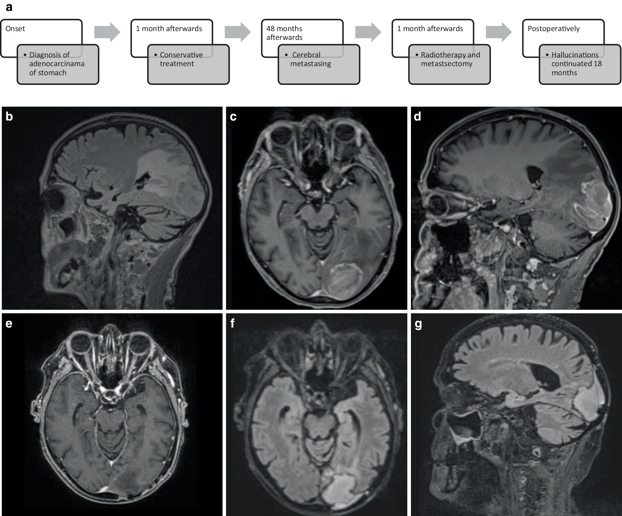 Visual hallucinations after resection of cerebral metastases: two patients with complex phantom images