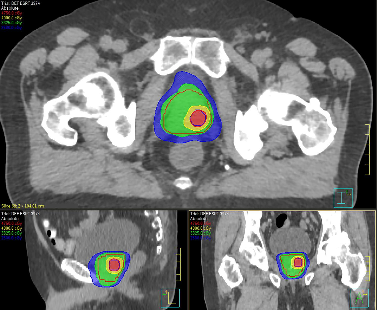 Stereotactic body radiotherapy (SIB-VMAT technique) to dominant intraprostatic lesion (DIL) for localized prostate cancer: a dose-escalation trial (DESTROY-4).